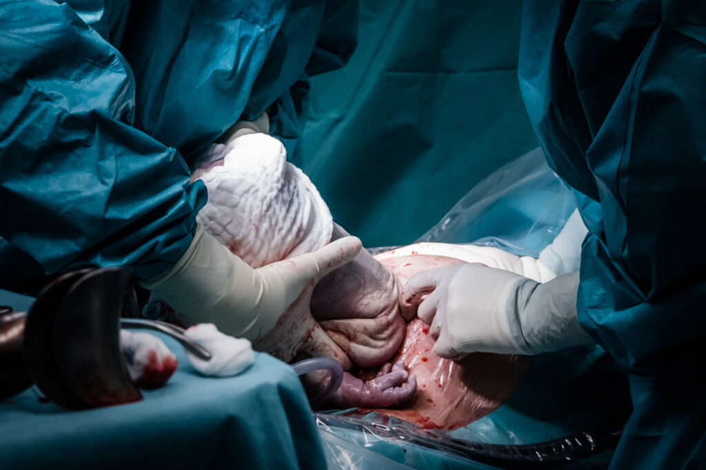 Ein Baby wird per Sectio im OP geboren.